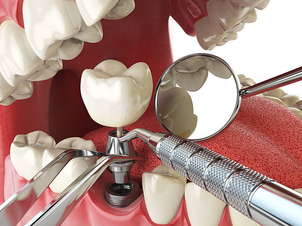 Best Emergency Dental Extractions in Nederland, CO